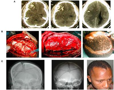 <mark class="highlighted">Cranioplasty</mark> Following Decompressive Craniectomy
